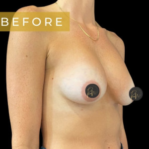 Case #6309 – Breast Revision/Correction