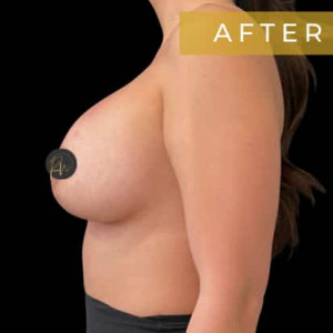 Case #6315 – Breast Lift with Breast Augmentation