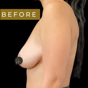 Before Image: Case #6315 – Breast Lift with Breast Augmentation - other