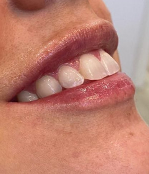 Lip filler by Rachel Chetney, RN