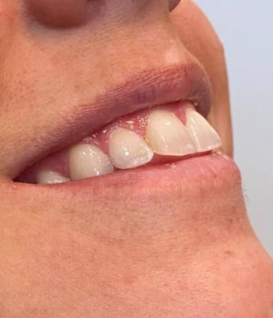 Lip filler by Rachel Chetney, RN