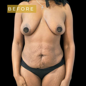Before Image: Case #6366 – Mommy Makeover - front