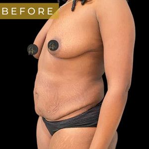 Before Image: Case #6366 – Mommy Makeover - left-front-oblique