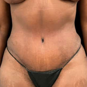 After Image: Case #6367 – Tummy Tuck - front
