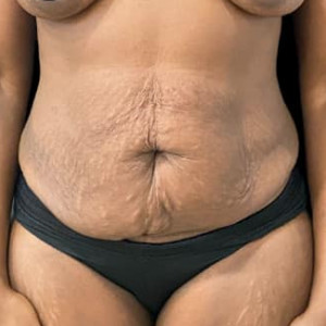 Before Image: Case #6367 – Tummy Tuck - front