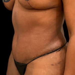 After Image: Case #6367 – Tummy Tuck - left-front-oblique