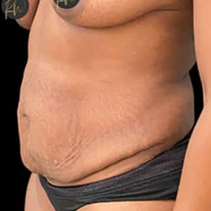 Before Image: Case #6367 – Tummy Tuck - left-front-oblique
