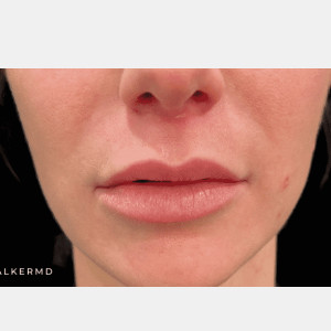After Image: Lip lift - front