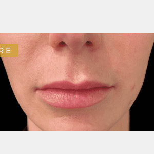 Before Image: Lip lift - front
