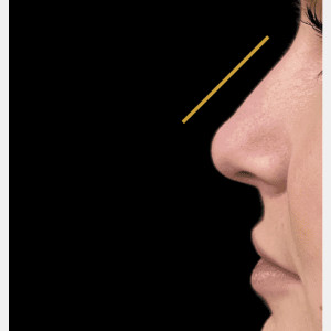 After Image: Nonsurgical rhinoplasty by Dr. Walker - other