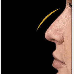Before Image: Nonsurgical rhinoplasty by Dr. Walker - other