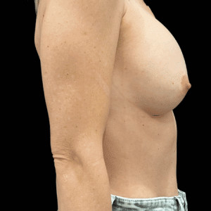 After Image: Breast Augmentation - other