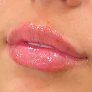 Lip filler by Rachel Chetney, RN