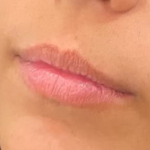 Lip filler by Rachel Chetney, RN
