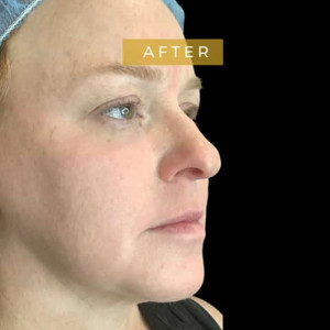 After Image: Facial fat grafting with laser resurfacing and RF microneedling - right-front-oblique