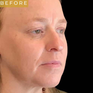 Before Image: Facial fat grafting with laser resurfacing and RF microneedling - right-front-oblique