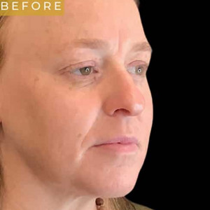 Before Image: Facial fat grafting with laser resurfacing and RF microneedling - right-front-oblique