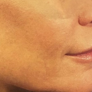 After Image: Multimodality Laser Resurfacing - other