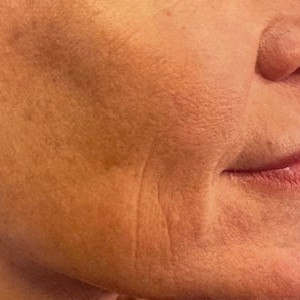 Before Image: Multimodality Laser Resurfacing - other