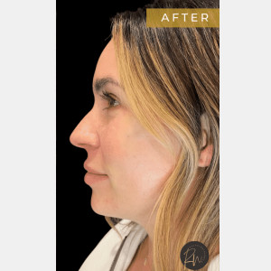 Chin filler by Rachel Chetney, RN.