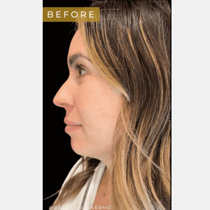 Chin filler by Rachel Chetney, RN.