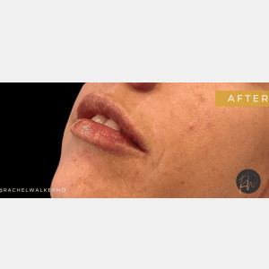 Lip filler with Rachel Chetney, RN.