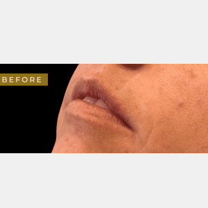 Lip filler with Rachel Chetney, RN.