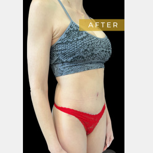After Image: Case #6588 Mommy Makeover and Abdominoplasty - right-front-oblique