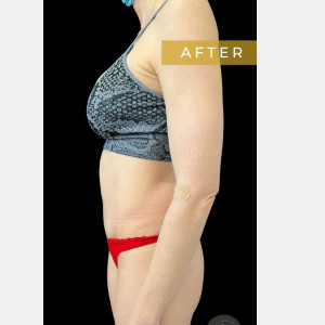 After Image: Case #6588 Mommy Makeover and Abdominoplasty - left-side