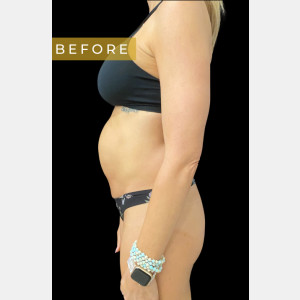 Before Image: Case #6588 Mommy Makeover and Abdominoplasty - left-side