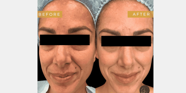 Case #6613 –  Halo Fusion for Melasma and Scarring