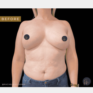 Case #6624 – Breast Asymmetry