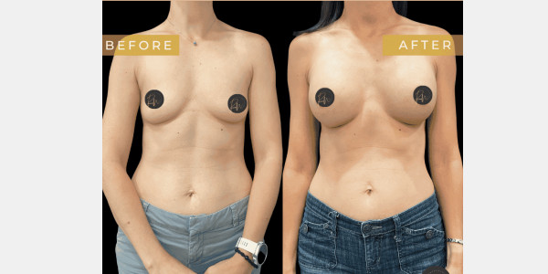 Case #6638 – Breast augmentation with gel implants