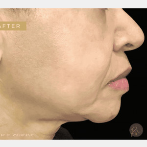 After Image: Case #6647 – Trifecta Profound multi modality laser treatment - other
