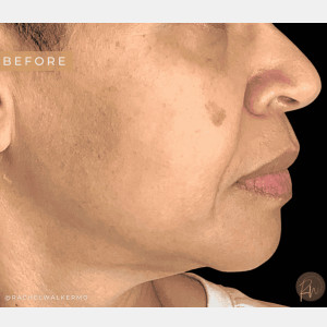 Before Image: Case #6647 – Trifecta Profound multi modality laser treatment - other