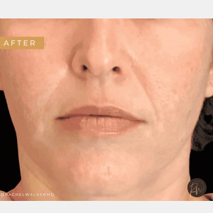 After Image: Case #6651 – Multimodality laser treatment - front