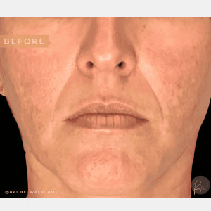 Before Image: Case #6651 – Multimodality laser treatment - front