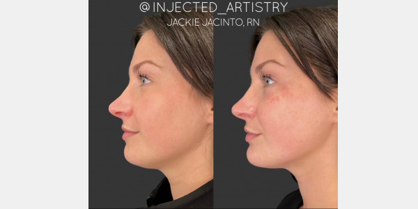 Chin filler by Jackie Jacinto RN