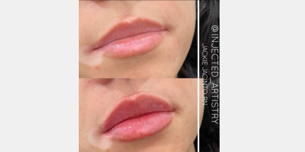 Lip filler by Jackie Jacinto RN