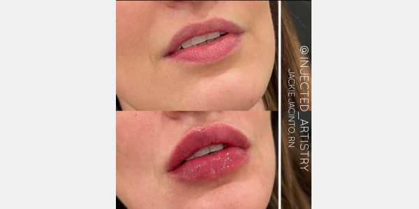 Lip filler by Jackie Jacinto RN