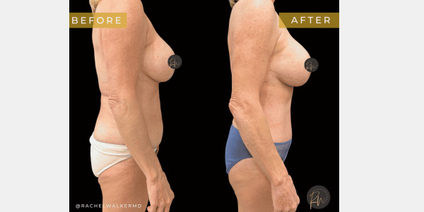 Mommy Makeover and Abdominoplasty