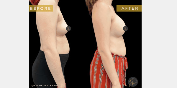 Breast and Breast Augmentation