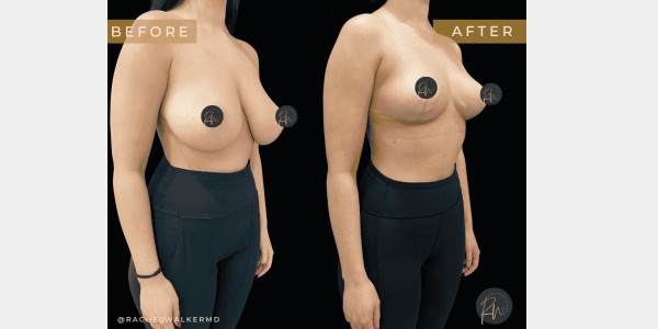 Case #6763- Breast Reduction