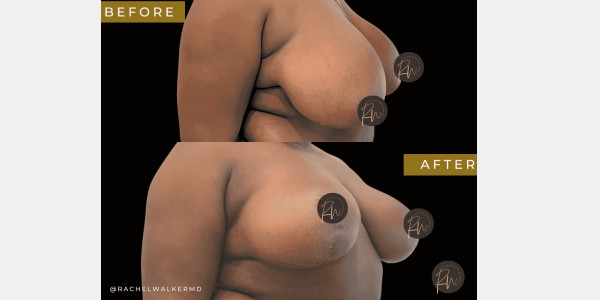 Case #6767 Breast Reduction with SAFElipo of braline
