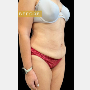 Before Image: Case #6826 – Tummy Tuck - other