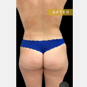 After Image: Case #6833 – SAFELipo - back