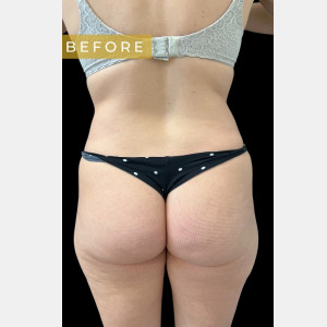 Before Image: Case #6833 – SAFELipo - back