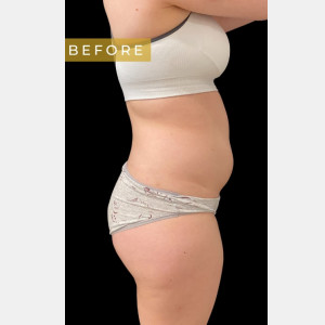 Before Image: Case #6838 – SAFELipo Circumferential Trunk - other