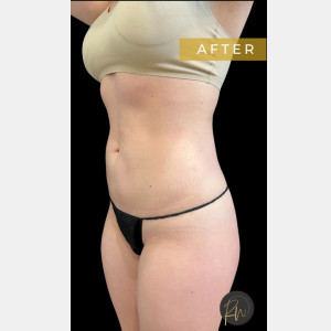 After Image: Case #6838 – SAFELipo Circumferential Trunk - other