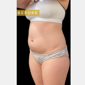 Before Image: Case #6838 – SAFELipo Circumferential Trunk - other